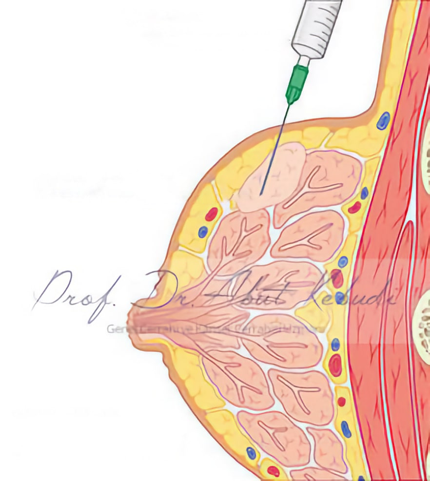 Fine Needle Biopsy - Abut Kebudi, M.D.