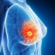 Breast Cancer: What is it? - Abut Kebudi, M.D.