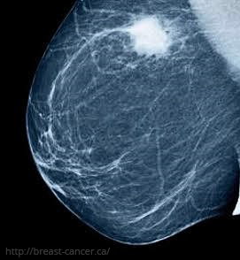 Breast Cancer Mamography - Abut Kebudi, M.D.

