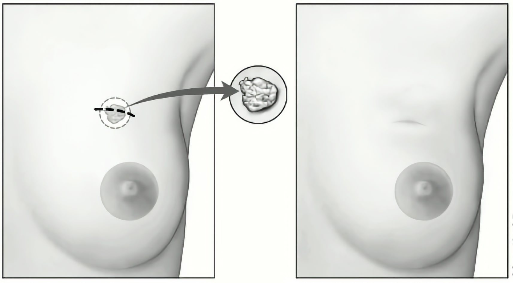 Early Stage Breast Surgery - Abut Kebudi, M.D.