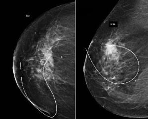 Marking Non-Palpable Breast Masses - Abut Kebudi, M.D.